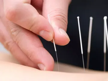 Acupuncture needles being placed into the skin by a hand